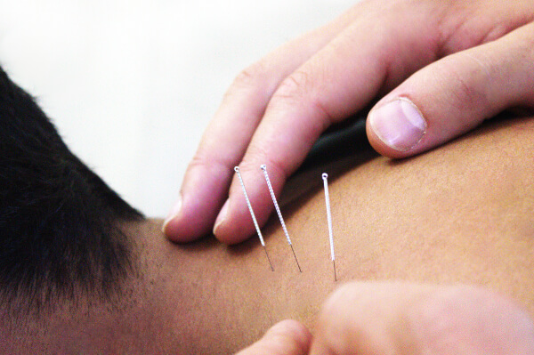 Our osteopaths at Blackheath Sports Clinic are highly qualified and also use Medical Acupuncture for pain relief