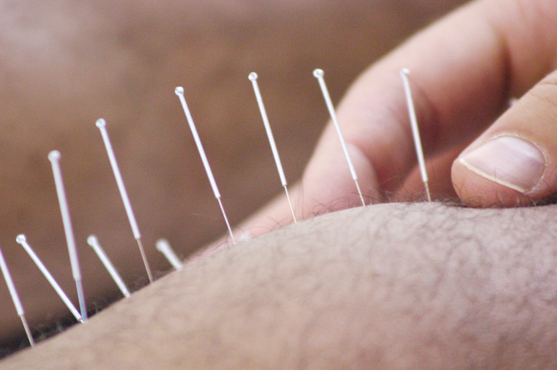 Intramuscular Needing (Medical Acupuncture) is available at Blackheath Sports Clinic to decrease muscle tension, reflief pain and treat minor sports injuries