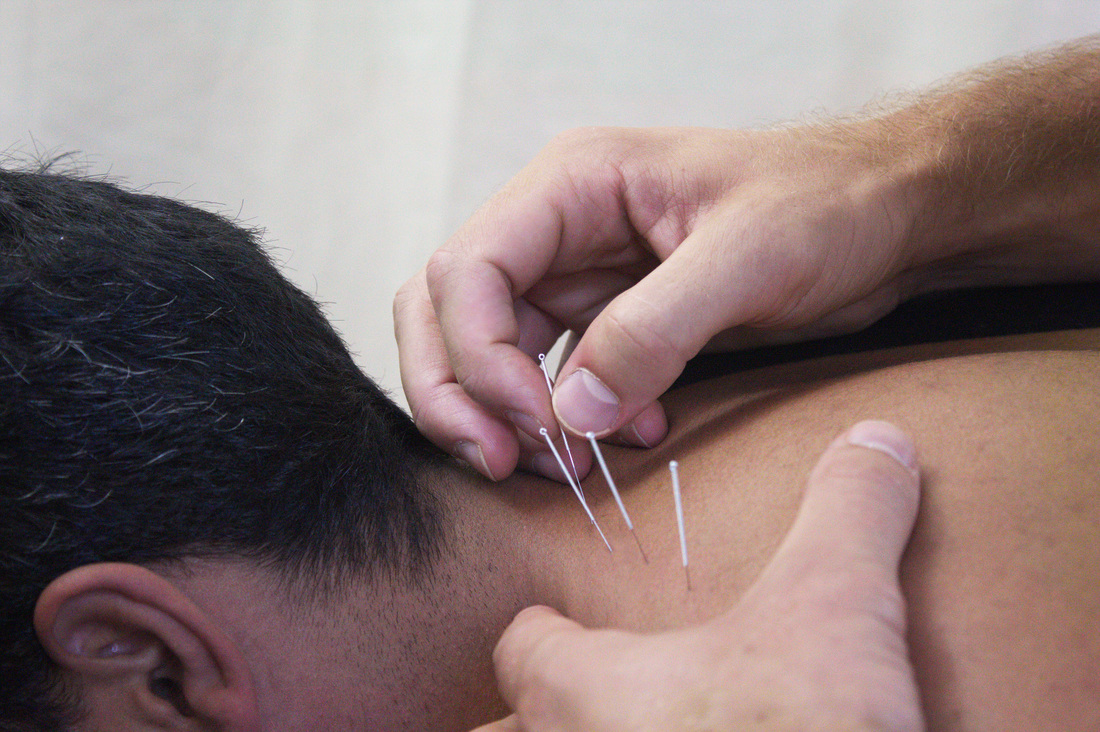 Medical Acupuncture is used at Blackheath Sports Clinic to treat muscular tension, neck pain and back pain